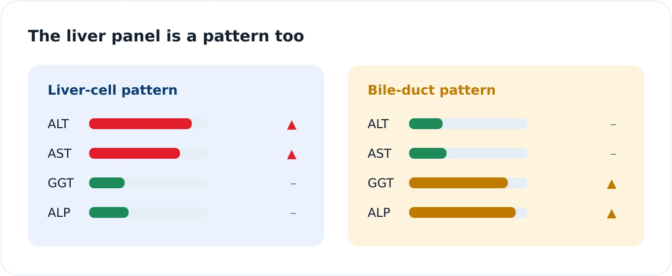 Comparison of two liver enzyme patterns, one hepatocellular with raised ALT and AST, and one cholestatic with raised ALP and GGT, showing how the combination points to different origins