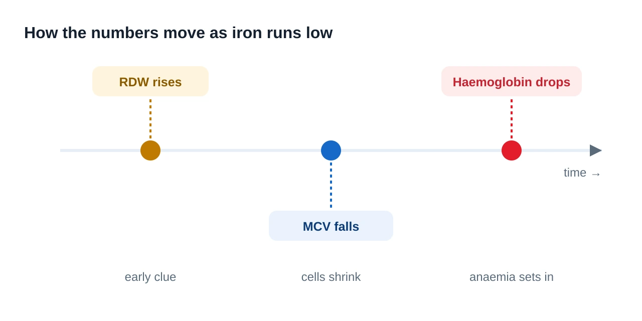 A timeline of developing iron deficiency showing RDW rising first, then MCV falling, then haemoglobin dropping